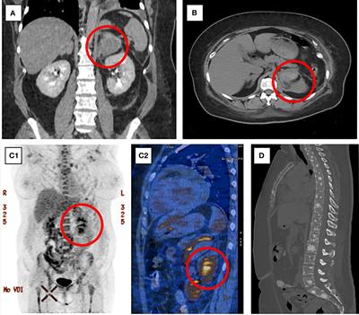 Case report: A challenging case of severe Cushing’s syndrome in the course of metastatic thymic neuroendocrine carcinoma with a synchronous adrenal tumor